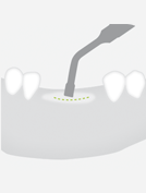 W&H B4 — Острое долото для расщепления альвеолярного гребня
