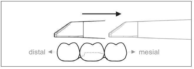 CEREC AC OMNICAM ПРОСТОЕ СКАНИРОВАНИЕ БЕЗ АНТИБЛИКОВОГО СПРЕЯ 9.jpg