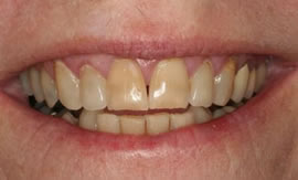 CEREC AC OMNICAM ПРОСТОЕ СКАНИРОВАНИЕ БЕЗ АНТИБЛИКОВОГО СПРЕЯ 20.jpg