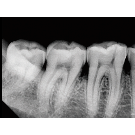 Vatech EzRay Air Wall - высокочастотный настенный дентальный рентген