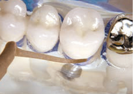 Acteon насадка для скайлера PH2L – из карбонового композита, для полировки и чистки керамических и композитных виниров, вкладок, обработки шеек имплантатов и протезов, полировки металлических (золото, титан) поверхностей