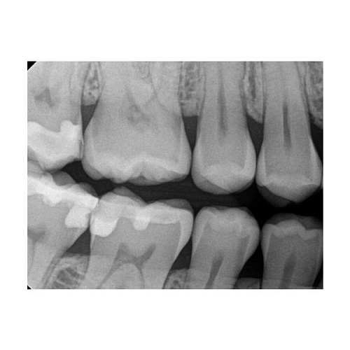 Carestream Kodak RVG 6200 - радиовизиограф