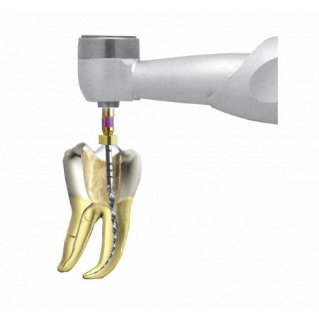 Anthogyr NiTi-Control - наконечник эндодонтический (128:1-понижающий) для любых типов NiTi инструмента