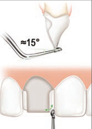 Acteon PMV3 – Внутренняя половинка шарика с алмазным покрытием
